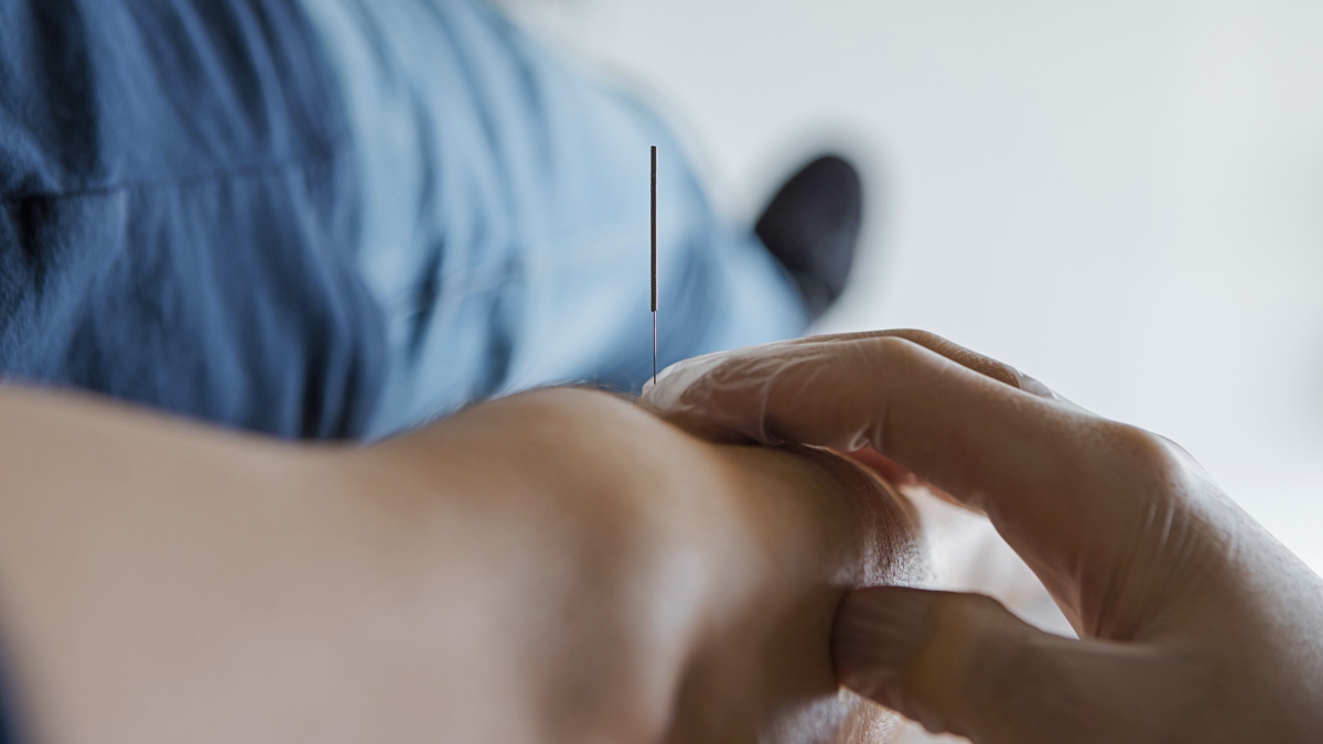 Close Up Of A Needle Stuck Into A Male Patient's Arm During A Dry Needling Session