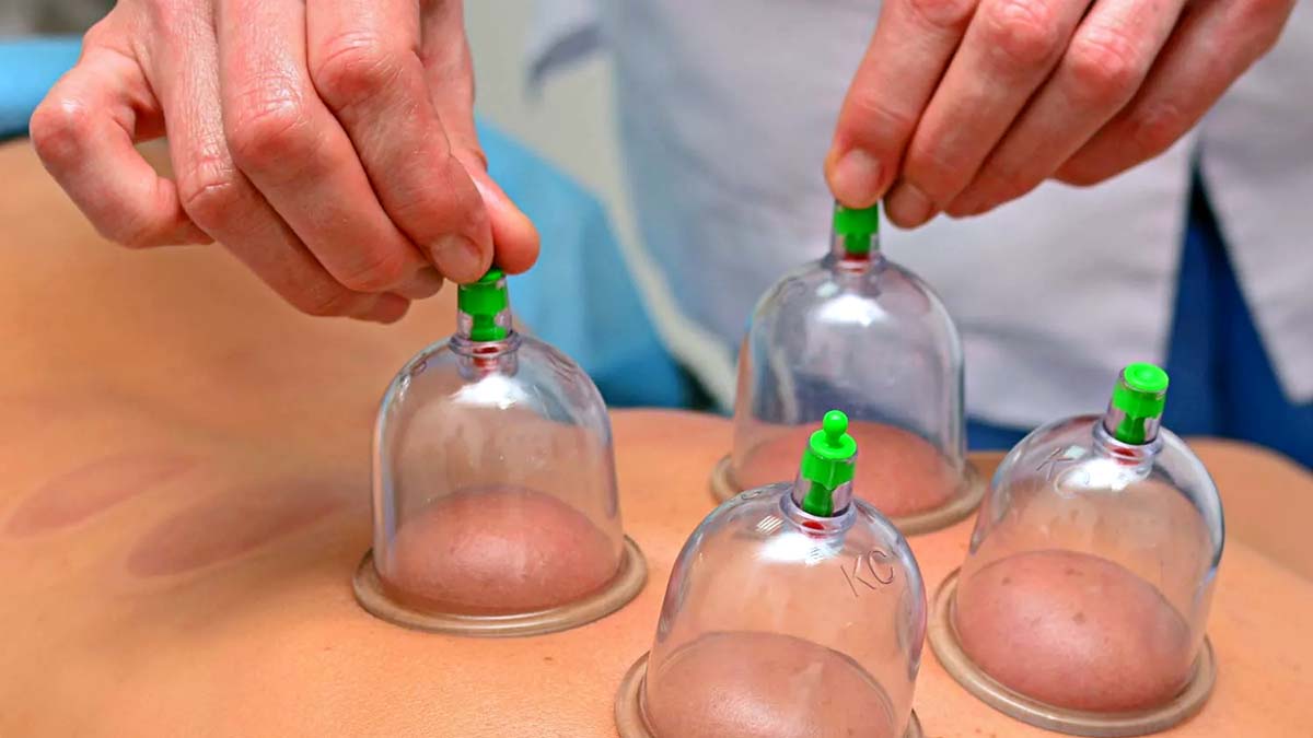 Close Up Of Physical Therapist's Hands Performing Cupping On Athelte's Back